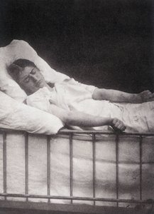 Hystero Epilepsie - Attacco di tetanismo in “Iconografia fotografica della Salpêtrière: servizio del Sig. Charcot” di Paul Regnard e Bourneville da Unknown artist