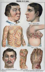 Malattie della pelle: Eczema, herpes labiale, psoriasi, fuoco di Sant