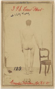 Frattura del terzo superiore del femore. Erastus Worthen, Corpo Co. B. 2nd Vermont Vols. 25 anni - Residenza Stockbridge VT. da Unknown artist