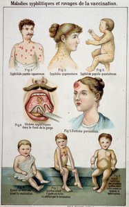 Tavola illustrativa delle diverse forme di malattie sifilitiche e dei pericoli della vaccinazione - in "Bilz, Natural Medication", fine XIX secolo