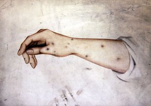 Studio di un avambraccio con condizione della pelle, c.1850 da William Lover
