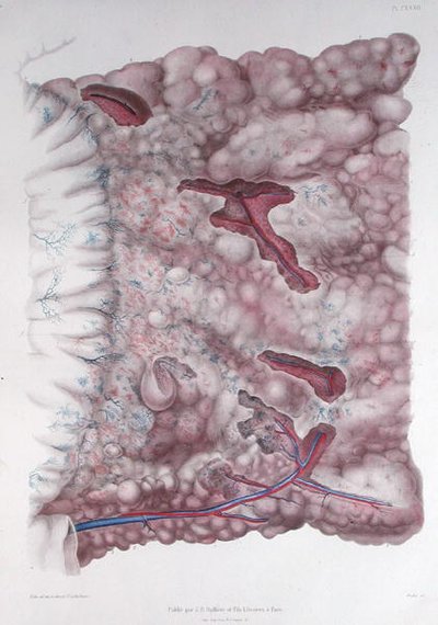 Cancro dell