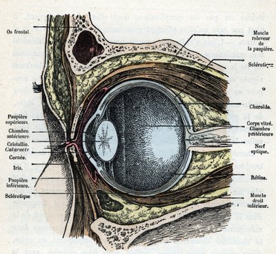 Sezione verticale di un bulbo oculare con cataratta. Incisione da 