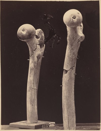 Esemplari di fratture da arma da fuoco del femore, c. 1867 (foto) da American Photographer