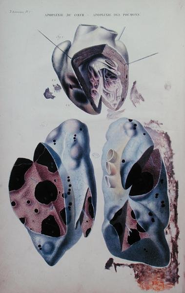 Apoplessia del cuore e dei polmoni, tavola illustrativa da 