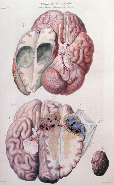 Tumori cancerosi del cervello, da 