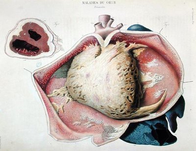 Pericardite, tavola che raffigura malattie cardiache da 