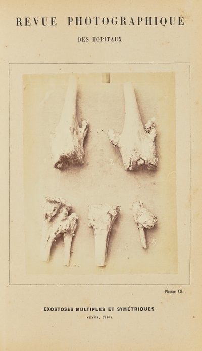 Esostosi multiple simmetriche, femore, tibia da Arthur de Montmeja