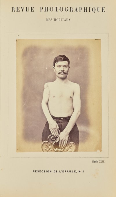 Resezione della spalla, numero 1 da Arthur de Montmeja