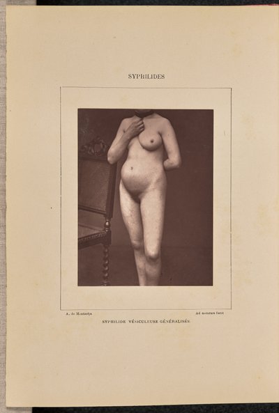 Sifilide vescicolare generalizzata da Arthur de Montmeja