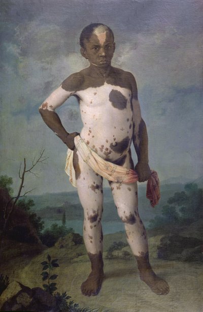 Bambino con vitiligine, 1786 da Brazilian School