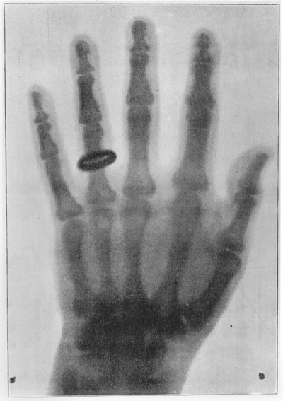 Radiografia della mano sinistra di Anna Bertha Ludwig, moglie di Röntgen da Carl August Voller