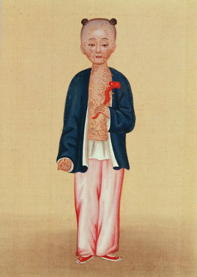 Bambino con vaiolo da Chinese School