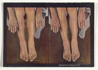 Dermatite esfoliativa da Dr. Selden I. Rainforth