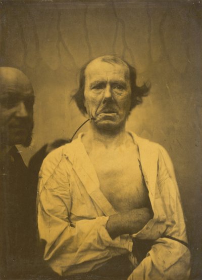 Espressione rilassata a sinistra, Disgusto a destra, 1854-1856, stampato 1862 da Duchenne de Boulogne