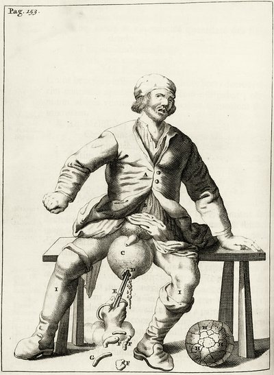 Drenaggio di liquido da un idrocele dello scroto, da Exercitationes Practicae circa Medendi Methodum di Frederik Dekkers, 1694 da Dutch School
