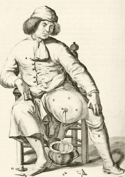 Drenaggio di liquido da un ascesso, da Exercitationes Practicae circa Medendi Methodum di Frederik Dekkers, 1694 da Dutch School