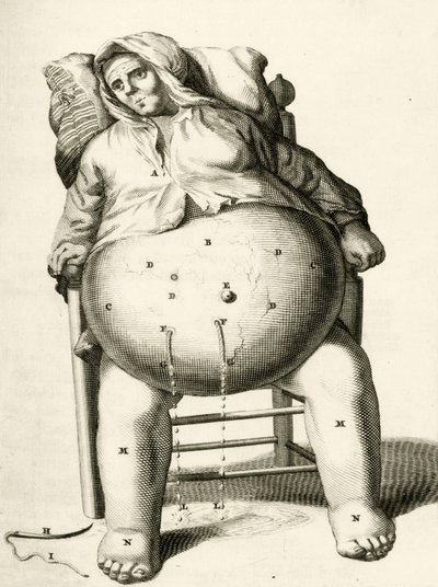 Drenaggio di liquidi da un ascesso, da Exercitationes Practicae circa Medendi Methodum di Frederik Dekkers, 1694 da Dutch School