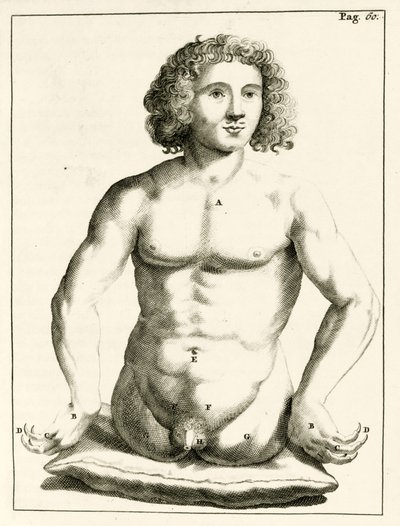 Esempio di difetti congeniti, da Exercitationes Practicae circa Medendi Methodum di Frederik Dekkers, 1694 da Dutch School