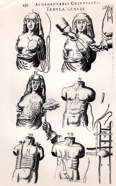 Operazione per il cancro al seno, da Armamentarii Chirurgici di Johannes Schultes pubblicato ad Amsterdam, 1672 da Dutch School