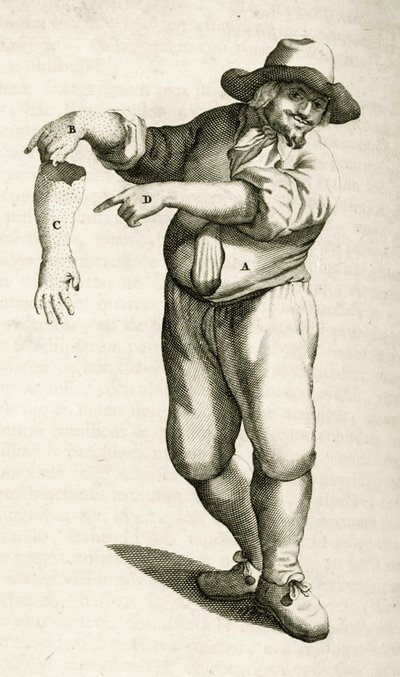 Rimozione della pelle morta con pustole, da Exercitationes Practicae circa Medendi Methodum di Frederik Dekkers, 1694 da Dutch School