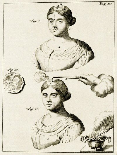 Trattamento di un epilettico, da Exercitationes Practicae circa Medendi Methodum di Frederik Dekkers, 1694 da Dutch School