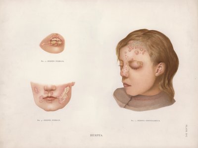 Malattie della Pelle: Herpes da English School