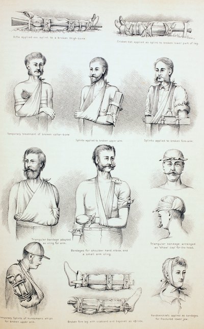 Trattamento temporaneo delle fratture, c.1890 da English School