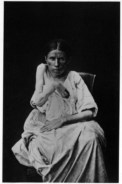 Fotografia di un paziente affetto da epilessia emiplegica, -in "iconografia fotografica della Salpetrière, Bourneville e P. Regnard, Parigi" da French Photographer