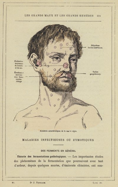Incidenti caratteristici della morva acuta (litografia a colori) da French School