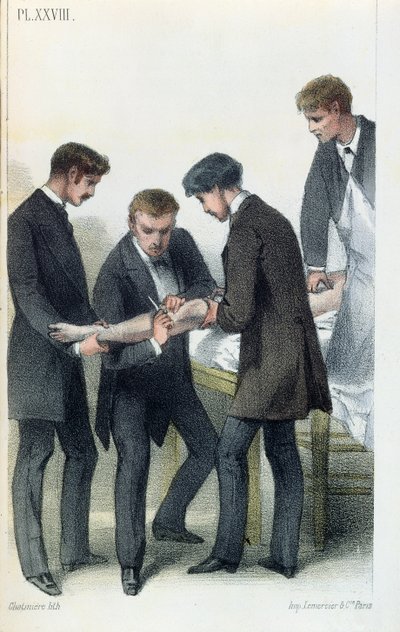 Amputazione di un braccio, da un manuale medico di Jean-Baptiste-Leon Dubreuil, c.1850-60 da French School