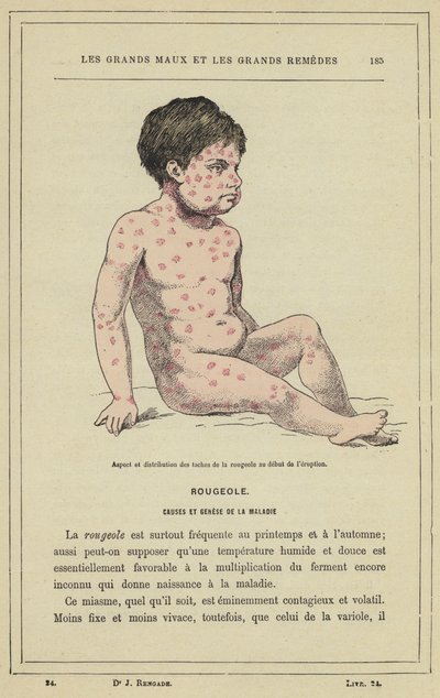 Aspetto e distribuzione delle macchie del morbillo all