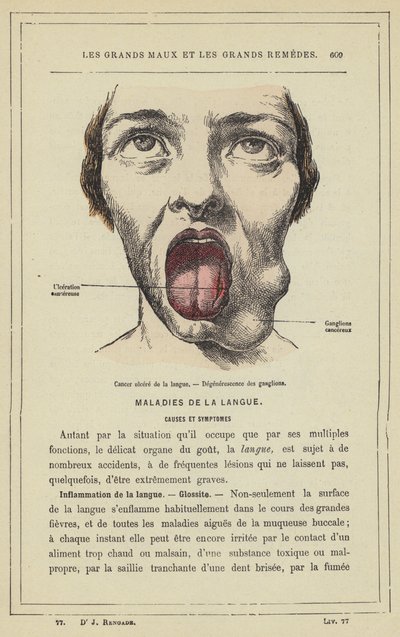 Cancro ulcerato della lingua, degenerazione dei gangli (litografia a colori) da French School