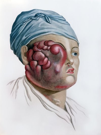 Scrofola cancerosa, da Description des Maladies de la Peau di Baron Jean Louis Alibert (1768-1837) Parigi, 1806 da French School
