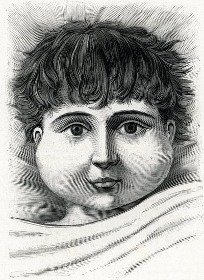 Bambino con parotite (incisione) da French School