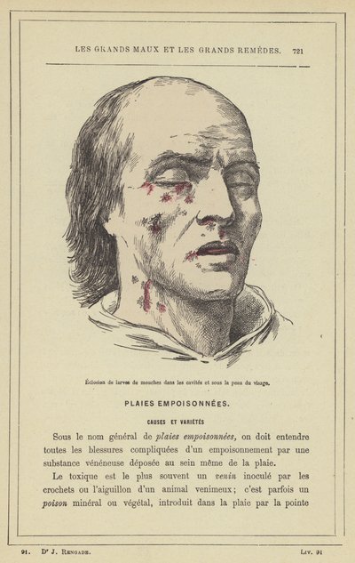 Schiusura di larve di mosche nelle cavità e sotto la pelle del viso (litografia a colori) da French School