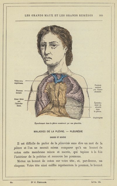 Versamento nella pleura causato da una pleurite da French School
