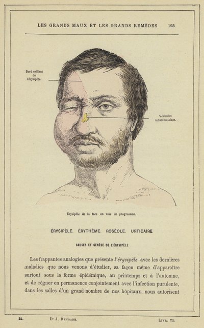 Erisipela del viso in via di progressione da French School
