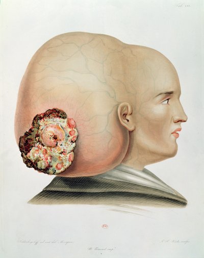 Fungo della dura madre, da Selecta Praxis Medico-Chirurgica di Alexander Auvert, Parigi, 1856 da French School