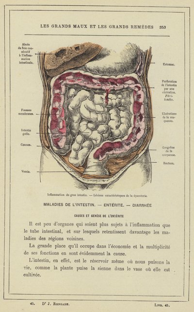 Infiammazione del colon, lesioni caratteristiche della dissenteria (litografia a colori) da French School