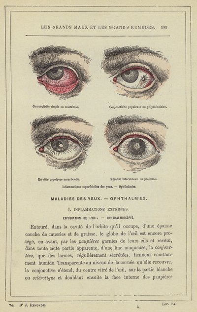Infiammazioni superficiali degli occhi, oftalmie da French School