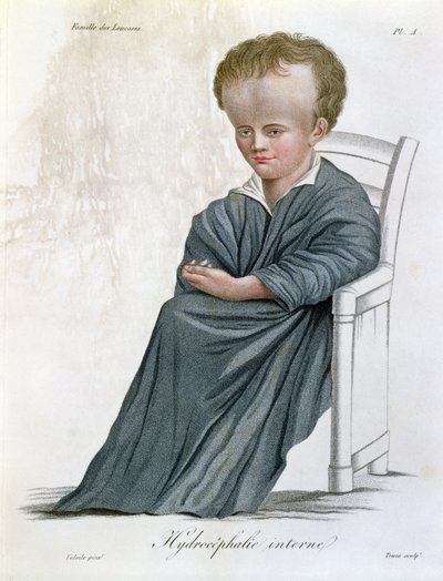 Idrocefalo interno, da Nosologie Naturelle di Baron Jean Louis Alibert (1768-1837) inciso da Tresca, 1817 da French School