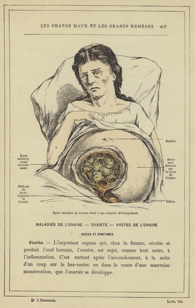Cisti areolare dell