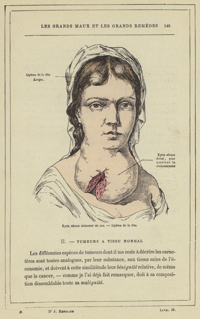 Cisti sierosa compartimentata del collo, lipoma della testa (litografia a colori) da French School