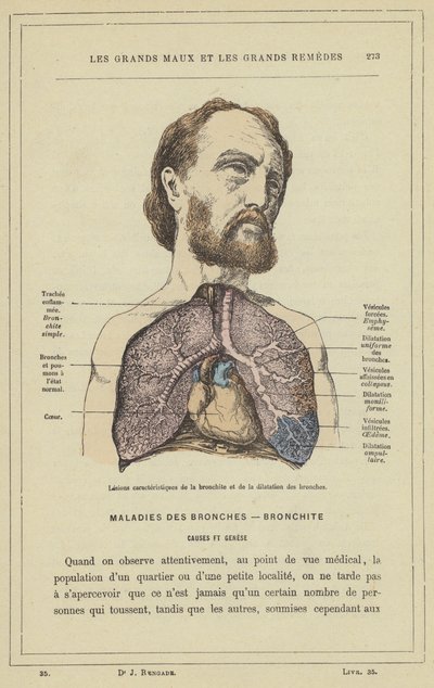 Lesioni caratteristiche della bronchite e della dilatazione dei bronchi (litografia a colori) da French School