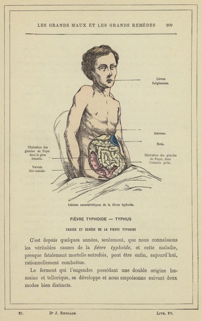 Lesioni caratteristiche della febbre tifoide (litografia a colori) da French School