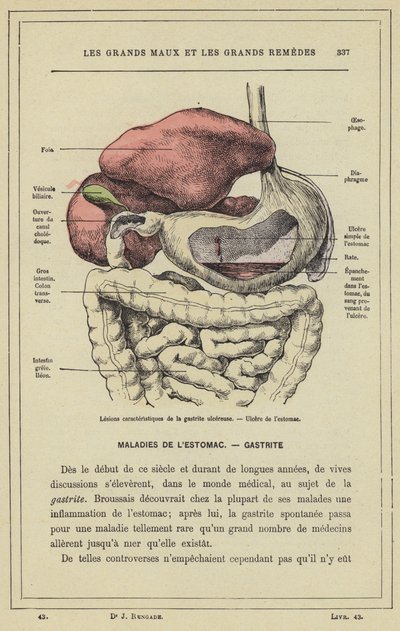Lesioni caratteristiche della gastrite ulcerosa, ulcera dello stomaco (litografia a colori) da French School