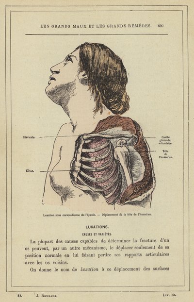 Lussazione sotto coracoidea della spalla, Spostamento della testa dell