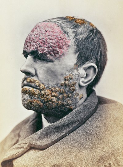 Uomo affetto da sifilide, da una fotografia scattata per la Clinique Photographique de l