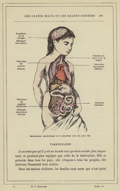 Manifestazioni caratteristiche della tubercolosi in una giovane ragazza da French School